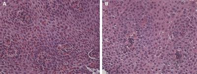Eosinophilic esophagitis improved by the discontinuation of sublingual immunotherapy for aeroallergens: a case report